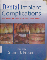 Image of DENTAL IMPLANT COMPLICATIONS : Etiology, Prevention,and Treatment