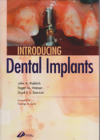 Image of Introducing Dental  Implant