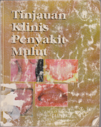 Tijauan Klinis Penyakit Mulut