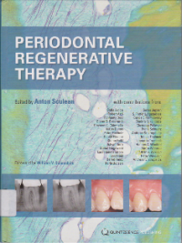 Image of PERIODONTAL REGENERATIVE THERAPY