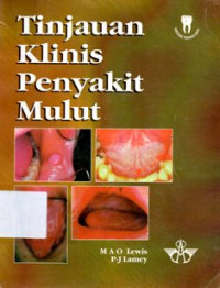 Image of Tinjauan Klinis Penyakit Mulut