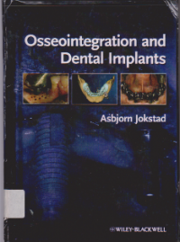 Image of OSSOEOINTEGRATION AND DENTAL IMPLANTS